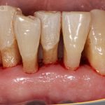 Testimonio de paciente con enfermedad periodontal avanzada