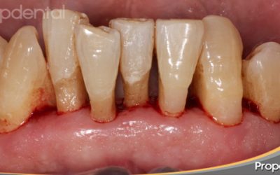 testimoniodepacienteconenfermedadperiodontal