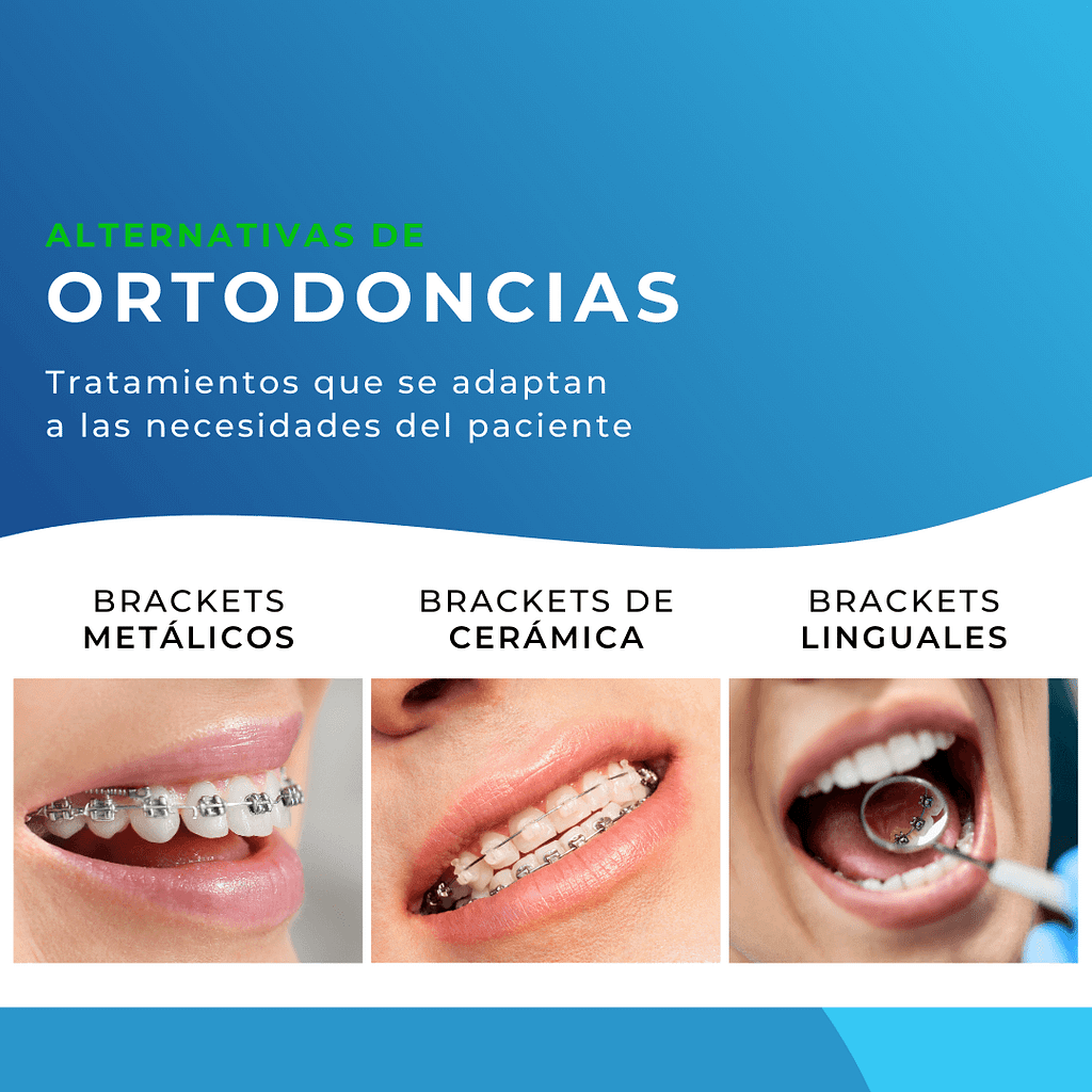 Beneficios de los Brackets Personalizados