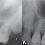 Cómo detectar signos tempranos de enfermedades dentales