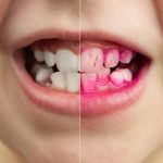 Cómo prevenir la acumulación de placa en la lengua