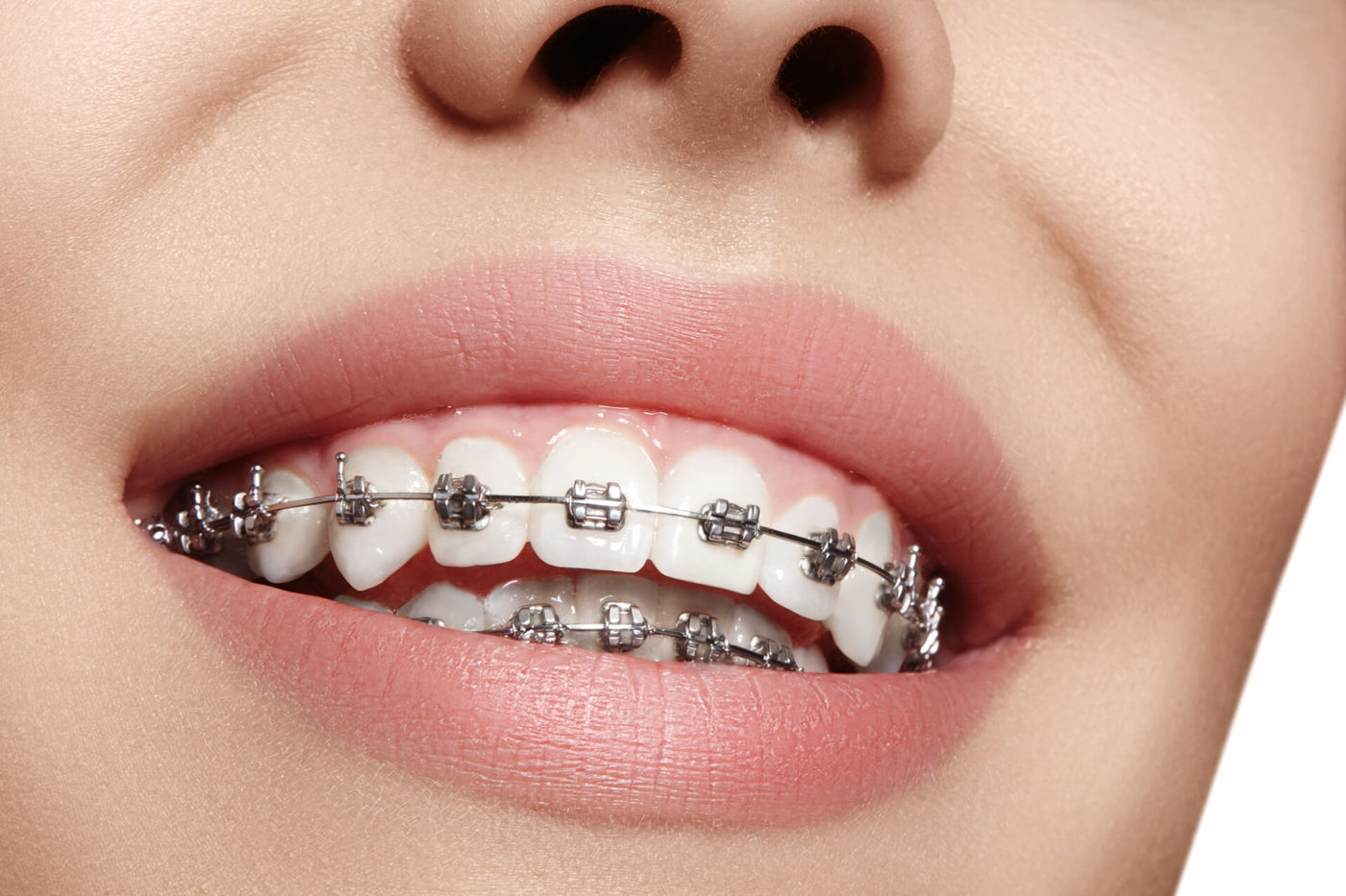 El Futuro de la Fabricación de Brackets Personalizados