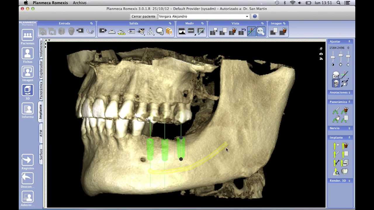 Flujo de Trabajo Digital en la Planificación de Implantes: Guía Paso a Paso