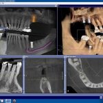 Herramientas digitales para la planificación de implantes