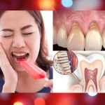 Opciones para tratar la hipersensibilidad dental