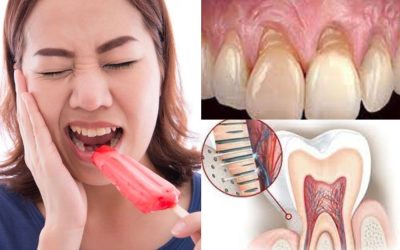 opcionesparatratarlahipersensibilidaddental 6