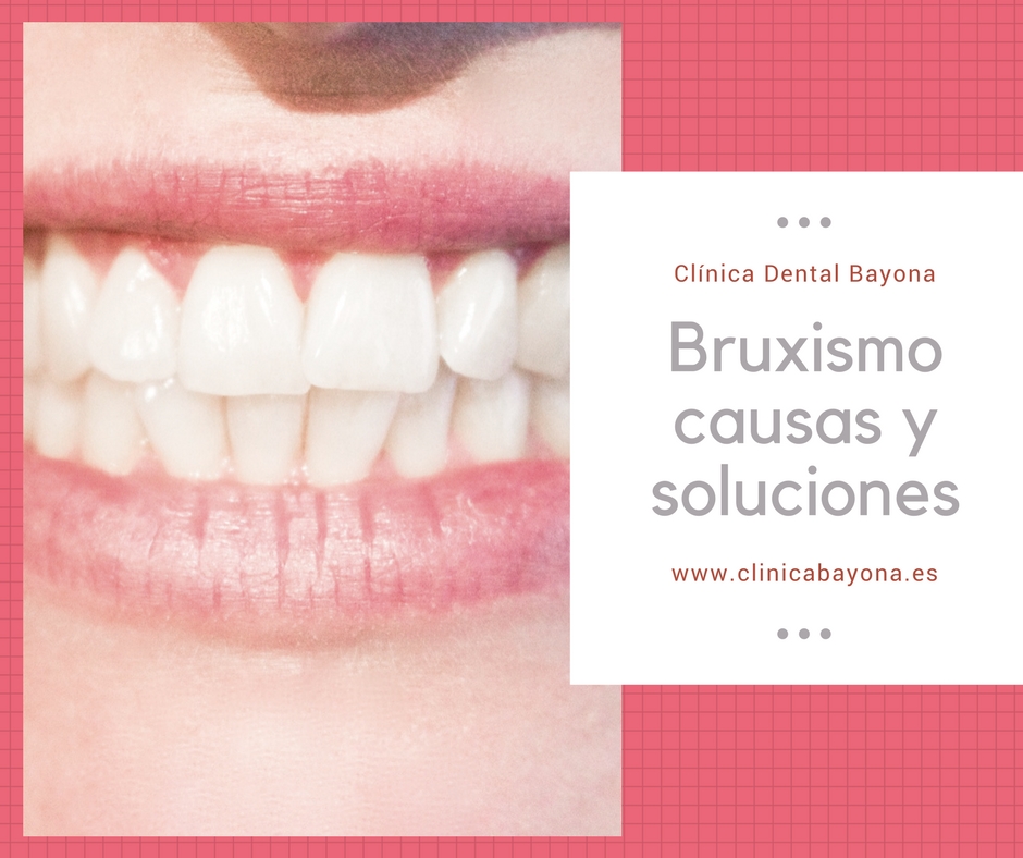Cómo enfrenté el bruxismo con dispositivos especializados 1 ¿Qué es el bruxismo y por qué decidí buscar soluciones?