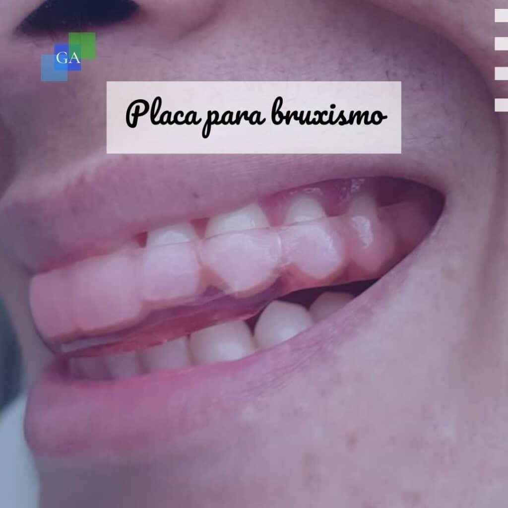 ¿Qué es el bruxismo y por qué es importante tratarlo a tiempo?