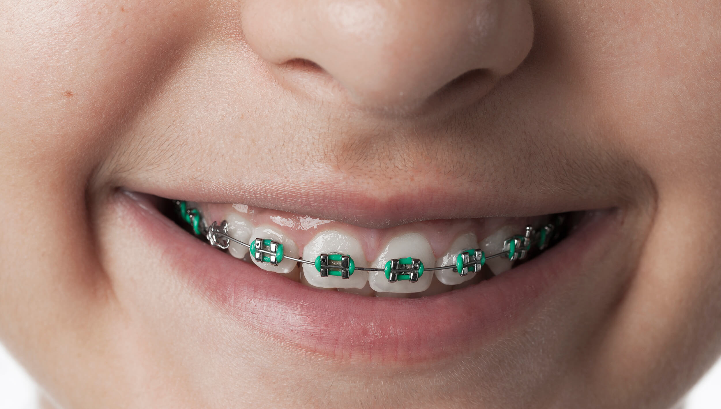 ¿Qué son los Brackets Personalizados?