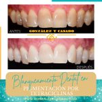 Tratamiento para dientes con manchas oscuras o tetraciclina