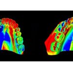 Cómo funcionan los escáneres intraorales en la odontología moderna