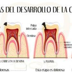 La prevención de caries en adultos mayores