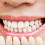 Mi camino hacia una sonrisa perfecta con carillas dentales