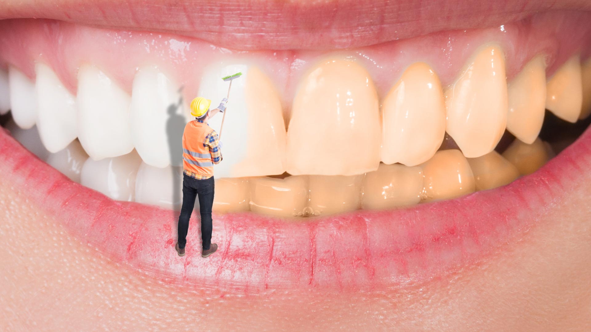 ¿Por Qué Elegí el Blanqueamiento Dental Casero Supervisado?