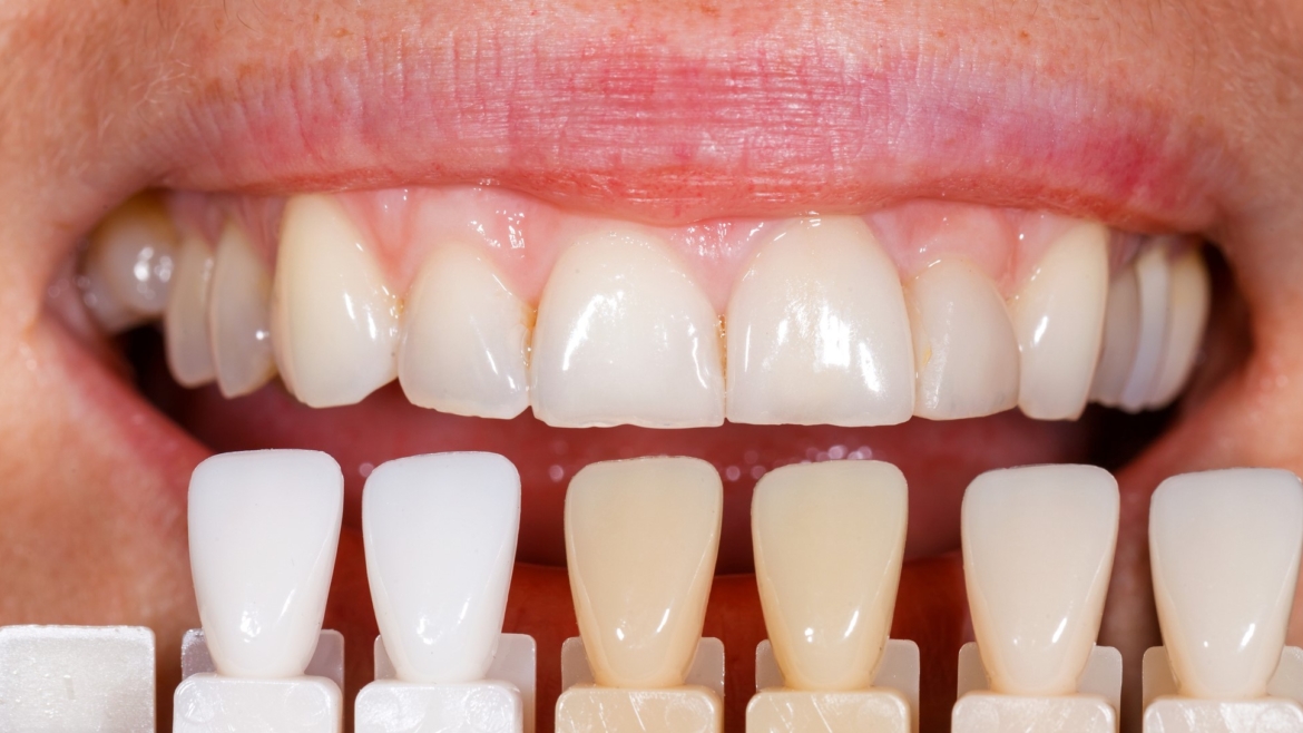 ¿Por qué elegí las carillas dentales?