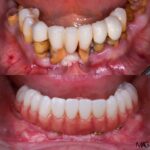 Tratamiento integral para la enfermedad periodontal