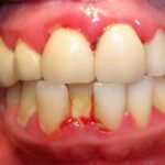 Cómo superé la gingivitis gracias a mi dentista