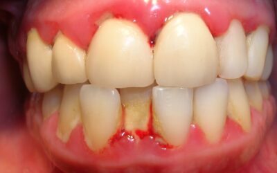 cmosuperlagingivitisgraciasamidentista 69