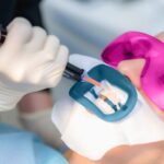 Equipos para blanqueamiento dental: tipos y cuidados