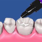 La aplicación de selladores dentales para prevenir caries