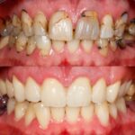 Testimonio de rehabilitación oral tras accidente dental
