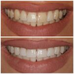 Tratamientos para restaurar la estética después de un trauma dental