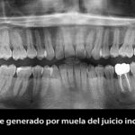 Cómo se realiza la extracción de muelas del juicio