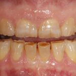Cómo tratar el desgaste dental por bruxismo