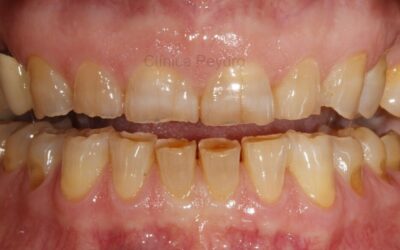 cmotratareldesgastedentalporbruxismo 69dbbf