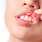 Cómo tratar las aftas bucales de forma natural
