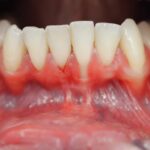 Tratamiento para la recesión gingival: técnicas modernas