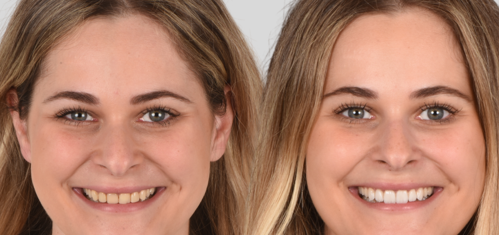 Clínica dental Chamberí dientes blancos